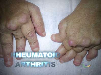 Medical Research on Rheumatoid Arthritis, Enrollment, Advances in Treatment